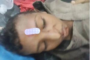 إصابة طفل بانفجار مقذوف من مخلفات الحوثيين جنوب الحديدة